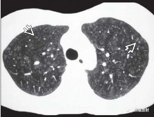 呼吸性细支气管炎丨ct表现诊断要点