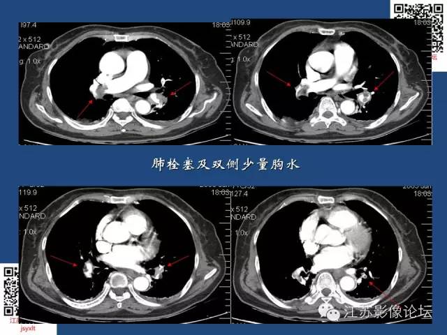 肺栓塞的影像学诊断【课件】