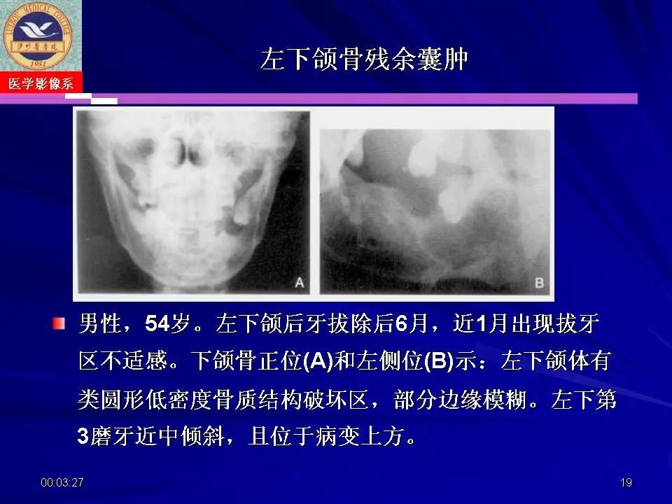 口腔颌面部囊肿肿瘤和肿瘤样病变的影像诊断丨影像天地