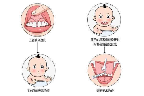 下唇系带断了怎么办