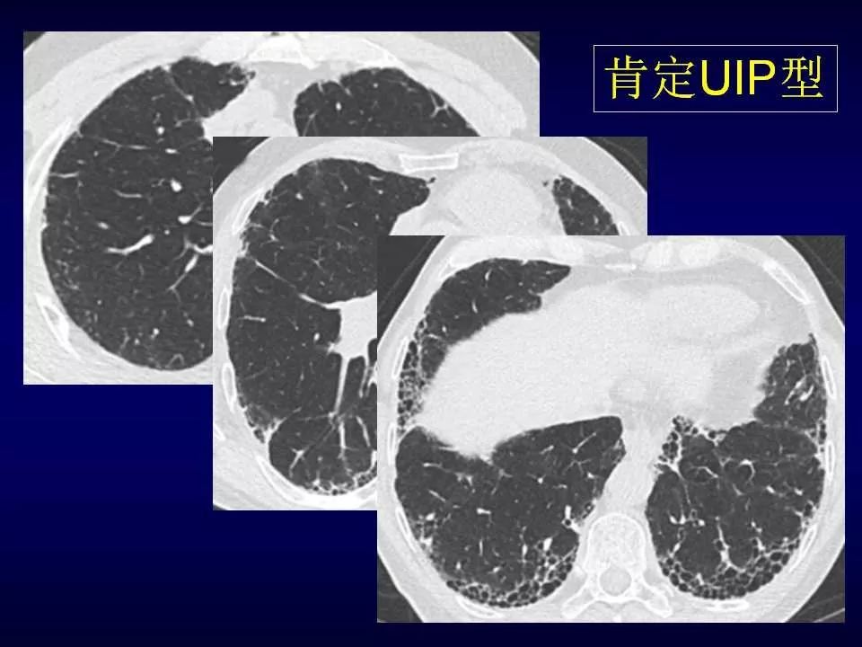 特发性肺纤维化的ct诊断进展