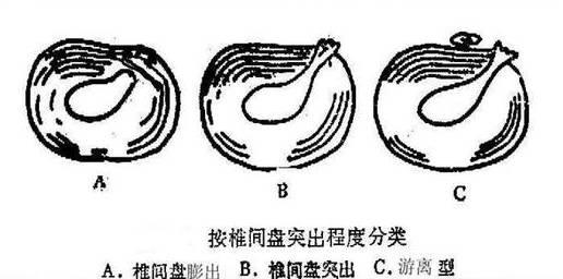 膨隆型,突出型,脱出游离型,schmorl结节及经骨突出型影像学上的腰间盘