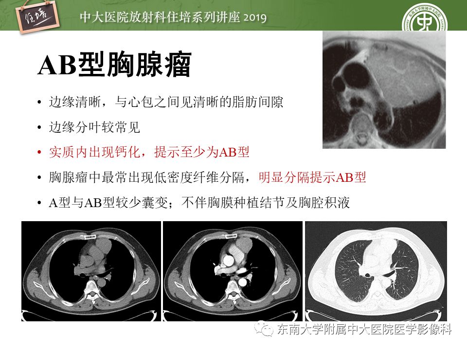 【2019住培系列讲座 第78期】胸腺上皮性肿瘤的影像诊断及鉴别