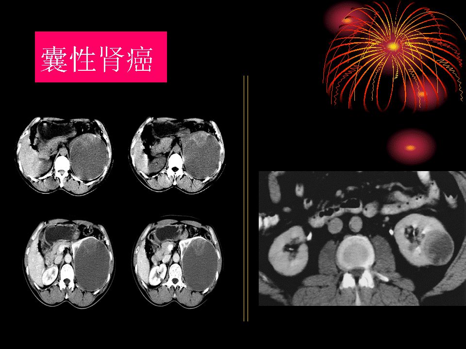 囊性肾癌的ct诊断