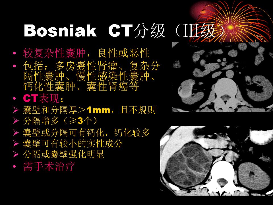 囊性肾癌的ct诊断