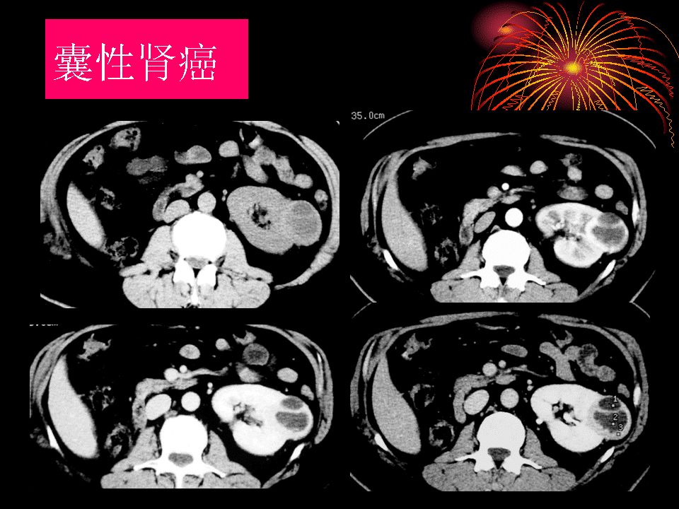 囊性肾癌的ct诊断