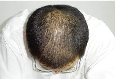 属于生理性脱发;病理性脱发是指头发异常或过度的脱落,导致毛发稀疏