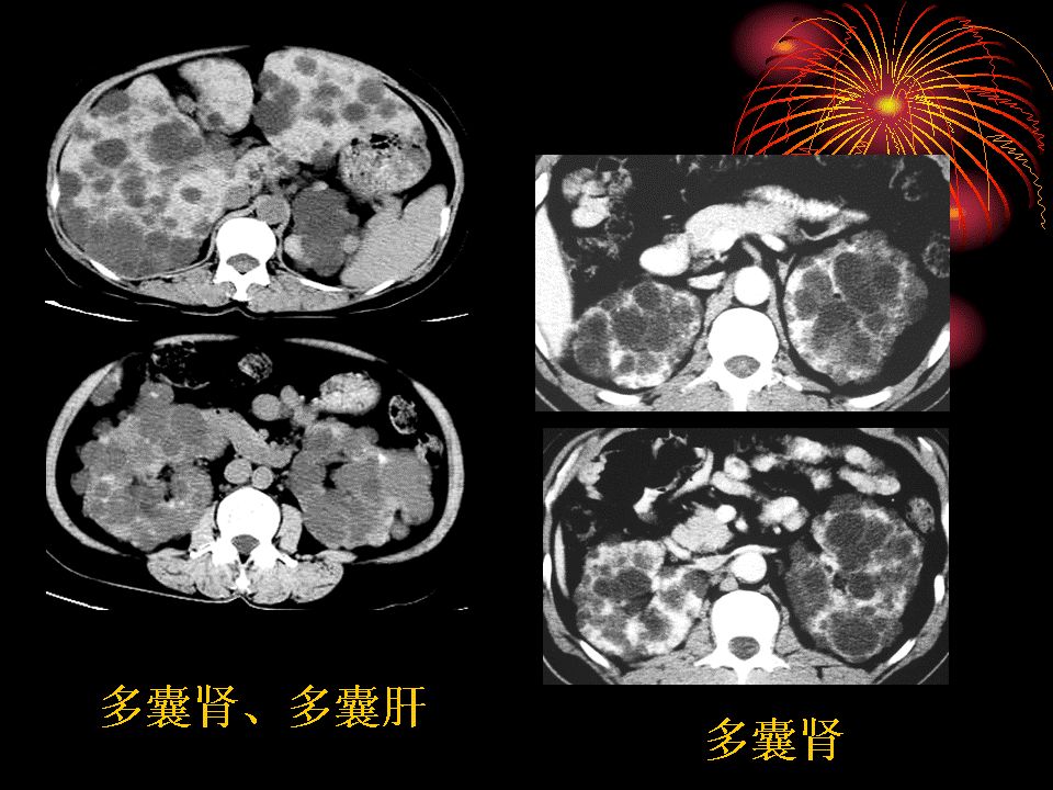 囊性肾癌的ct诊断