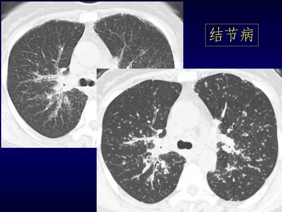 特发性肺纤维化的ct诊断进展