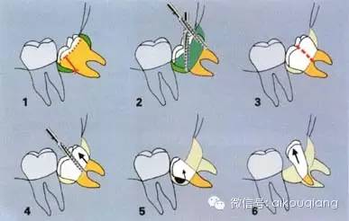 口腔麻醉拔牙术阻生牙拔除