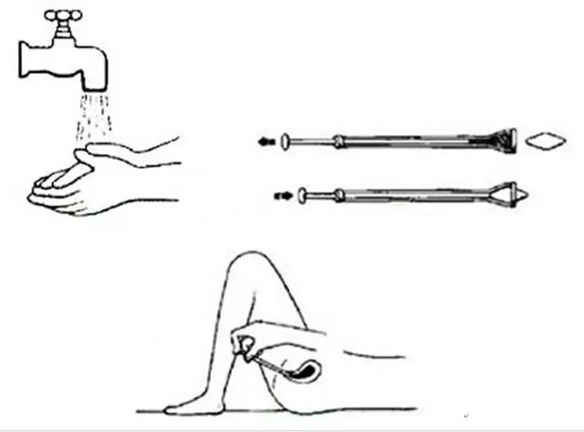 洗剂的使用方法 1,冲洗 将一定量的药液稀释后,借助阴道冲洗器冲洗