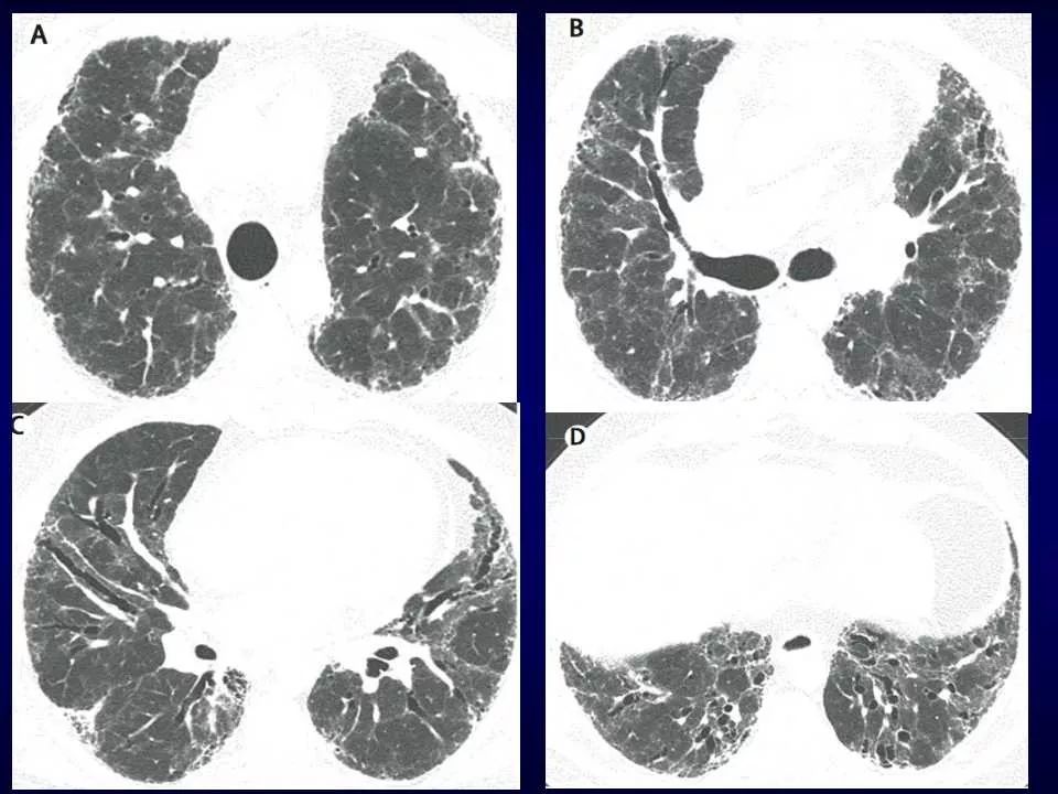 特发性肺纤维化的ct诊断进展