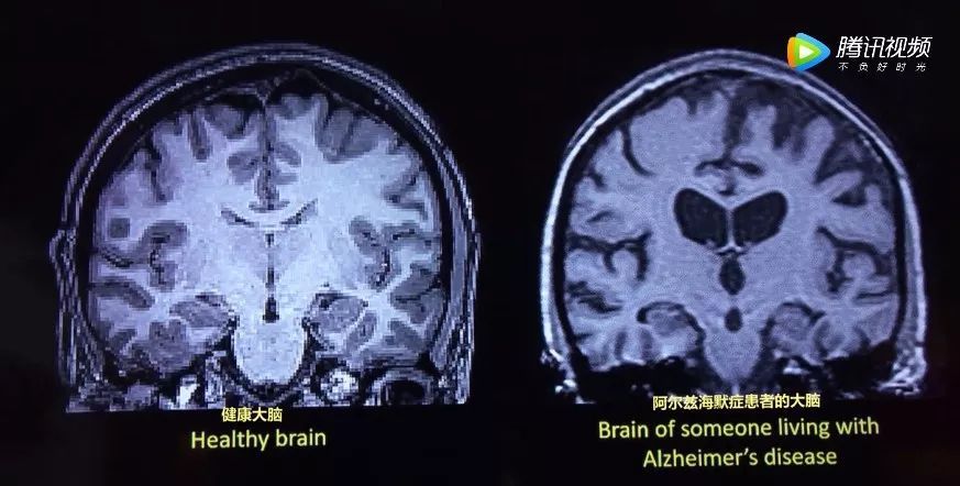 阿尔茨海默症音乐的力量真的超乎你的想象