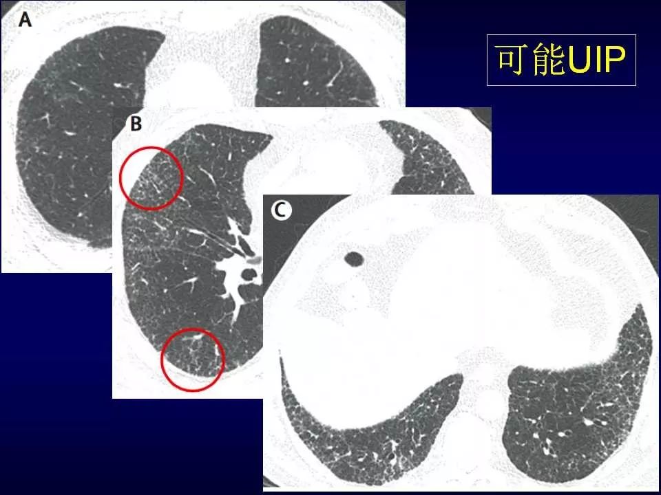 特发性肺纤维化的ct诊断进展