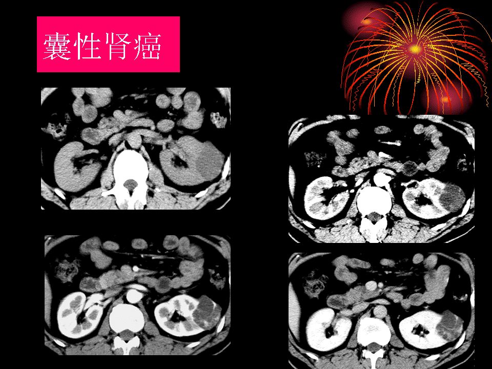 囊性肾癌的ct诊断