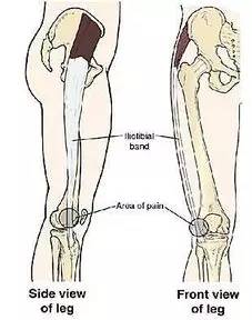 左大腿外侧疼痛怎么办