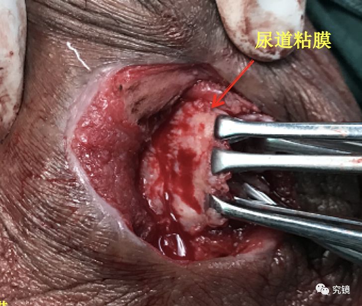 手术要点: 分离并剪除多于尿道粘膜 清除炎性疤痕纤维肉芽组织 闭合