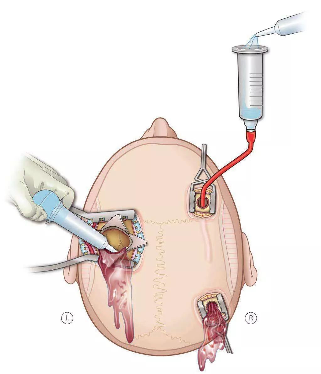 钻孔引流手术是神经外科较简单的一种手术,常常是神经外科菜鸟们的