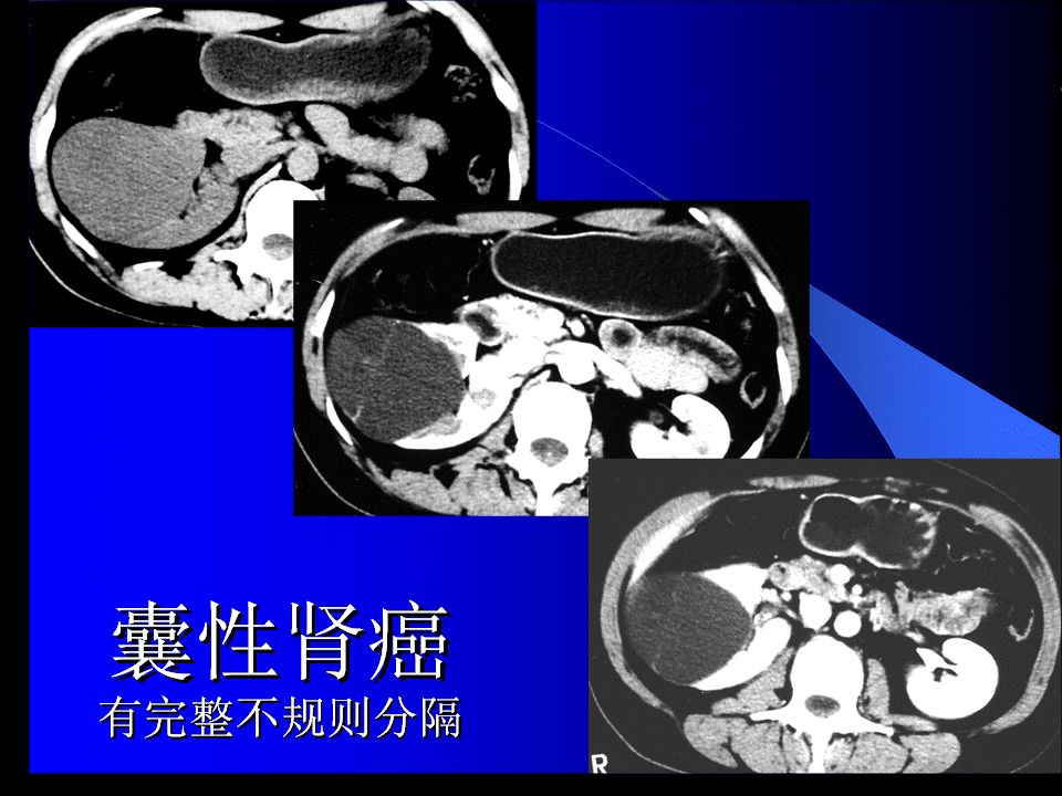 囊性肾癌的ct诊断