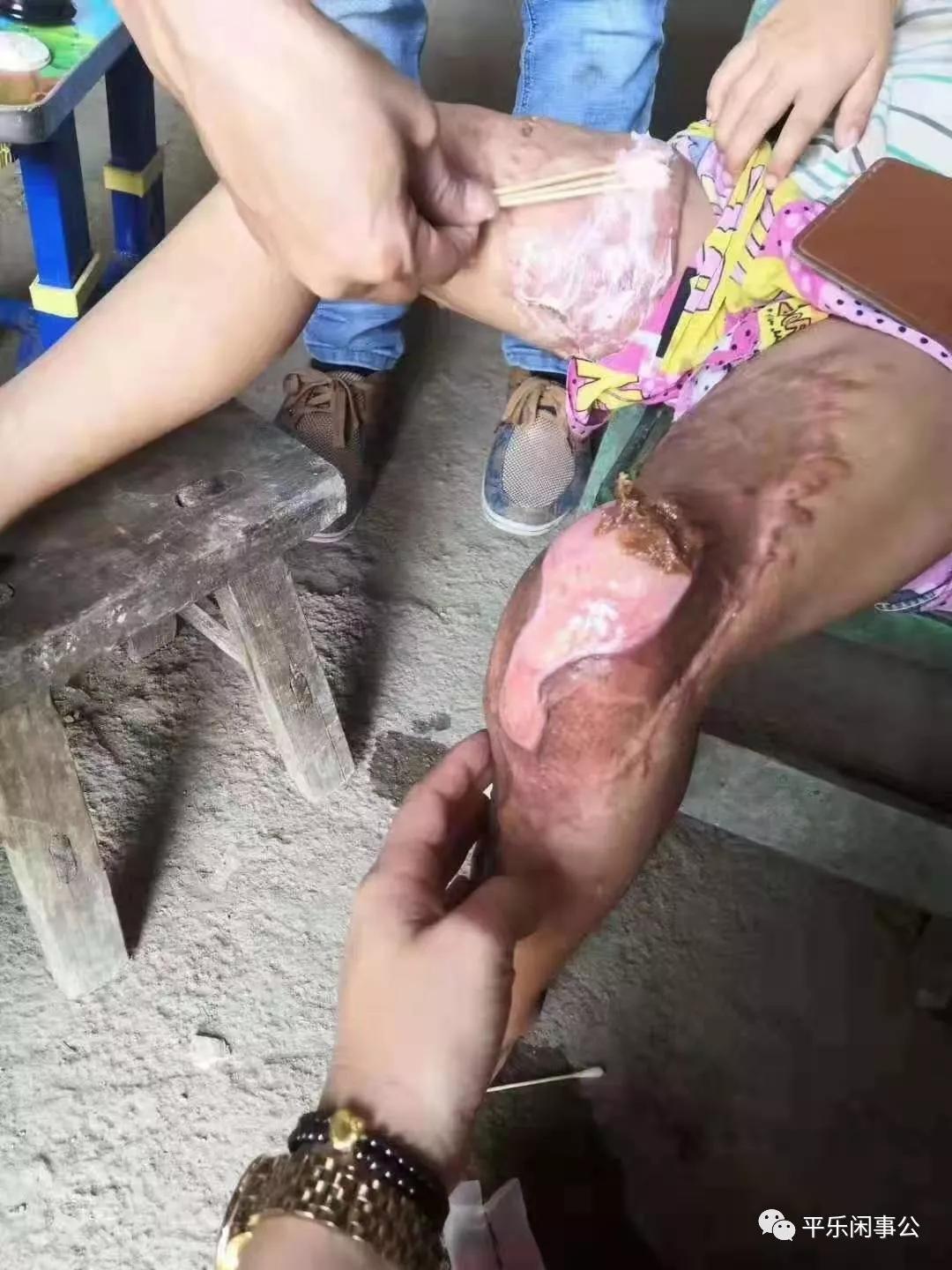 车祸后,小春利双腿受伤严重,这让她不得不接受自体植皮手术,在桂林924