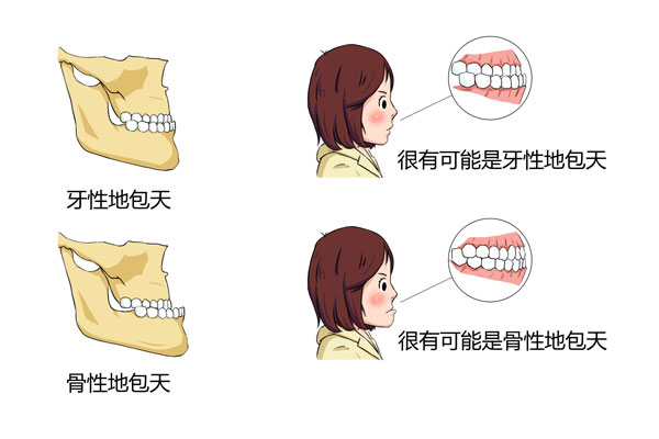 如何判断是骨性地包天