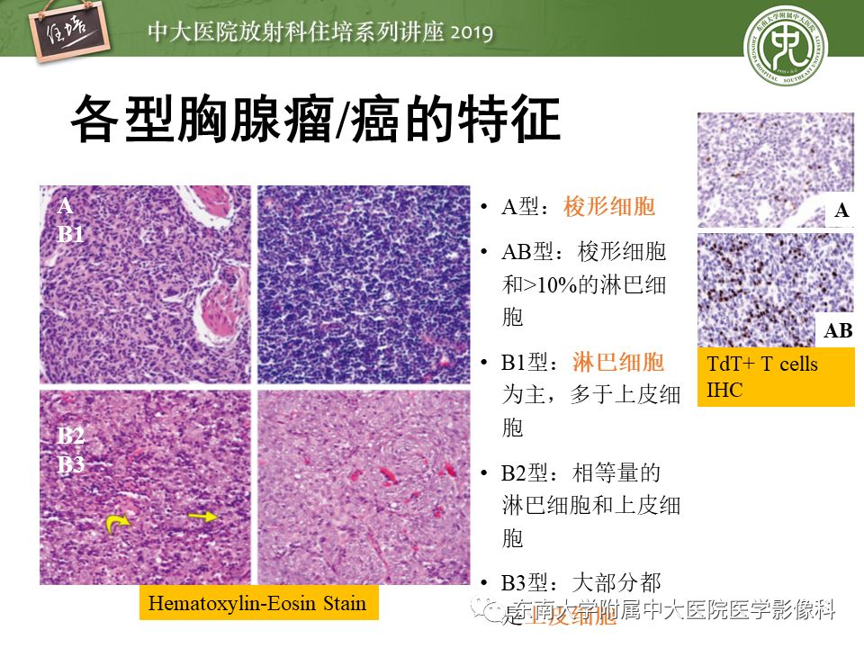 【2019住培系列讲座 第78期】胸腺上皮性肿瘤的影像诊断及鉴别