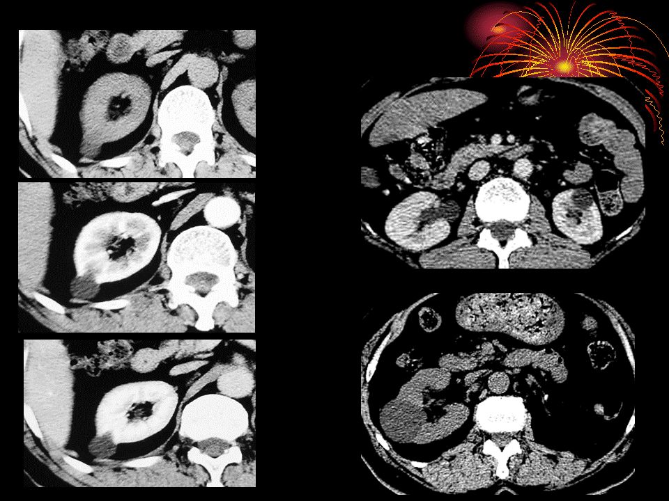囊性肾癌的ct诊断