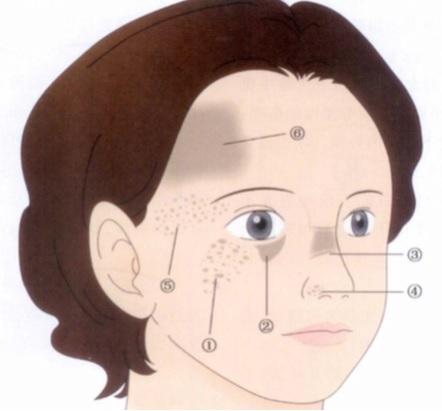 褐青色斑的6个典型分布部位及特征