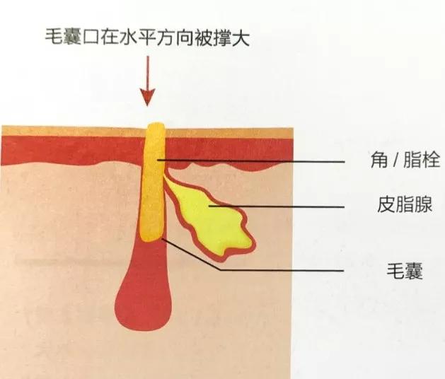 器质性毛孔粗大是因真皮基质损失而在垂直方向上形成凹陷.