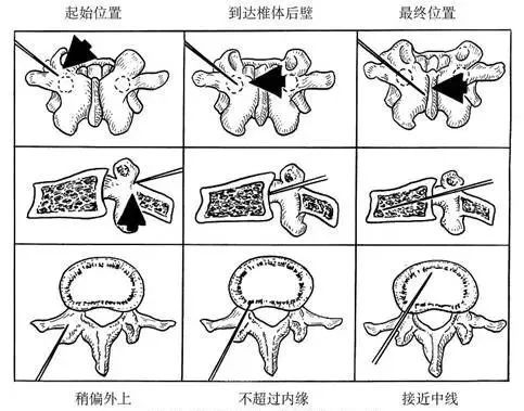 两根小细针,解决大问题||我院骨科熟练开展椎体成形术