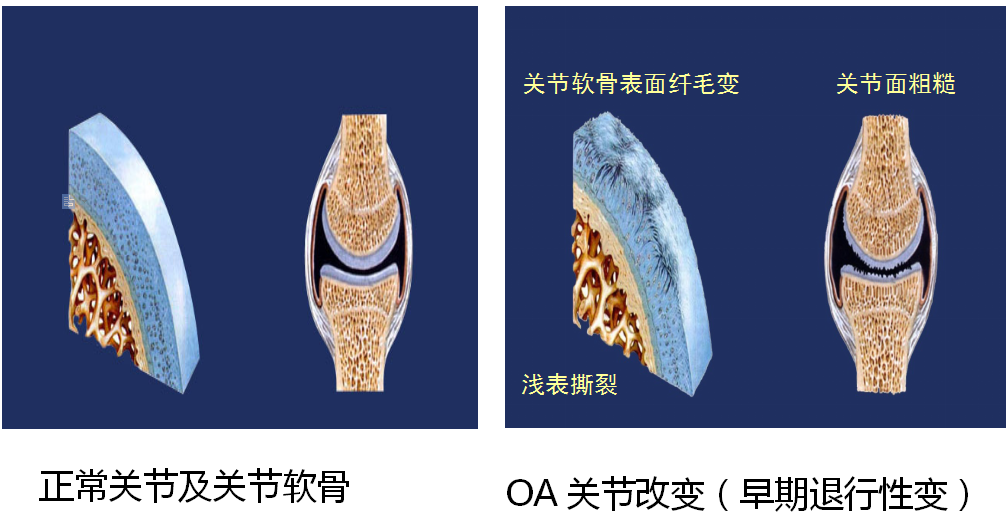 关节软骨改退行性变的过程