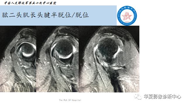 肱二头肌长头腱的点点滴滴您清楚吗