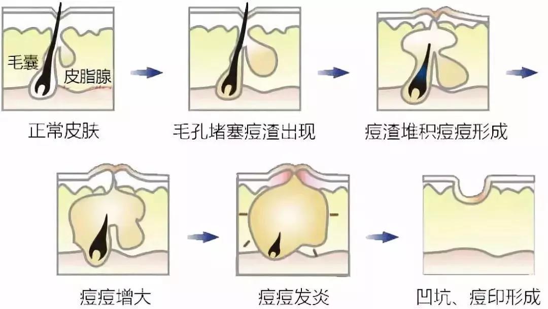 与皮脂,微生物一起堵塞毛囊,形成脂栓或毛囊管型,将毛孔撑大,因此