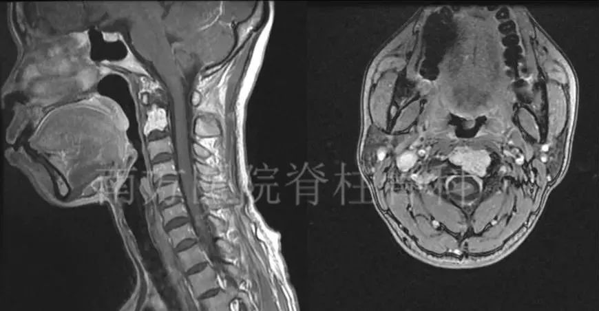 人口腔肉瘤_口腔卡波西肉瘤图片(2)