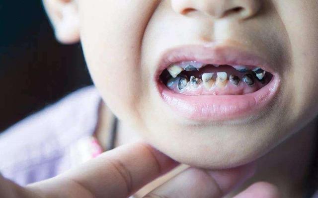 我国儿童乳牙龋齿率70%,宝宝多大适合刷牙?父母要知道
