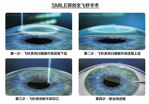 做眼睛近视手术的原理_做近视手术前必须要做眼部检查,医生根据检查的结果,评估你是否适合