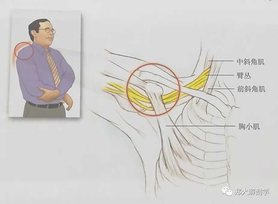 疼痛从肩部放射至锁骨上方的区域和上肢