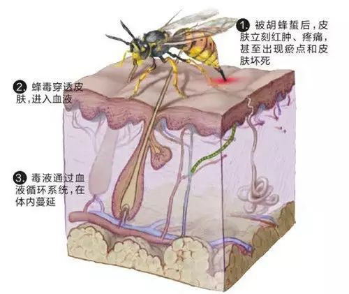 大腿被马蜂蛰了怎么办