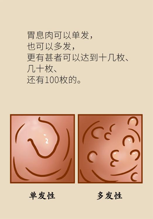 胃息肉会不会癌变