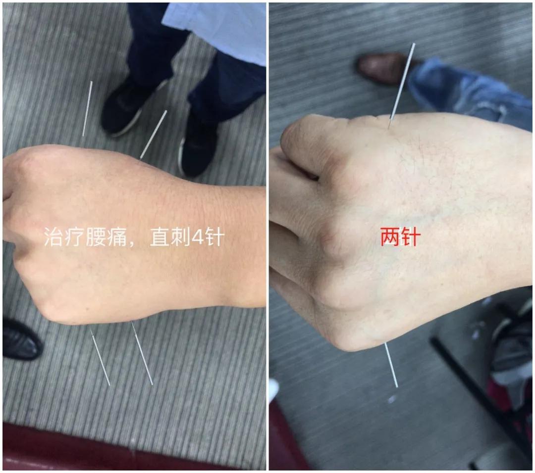 刘吉领新一针疗法31种针灸技巧一针一穴