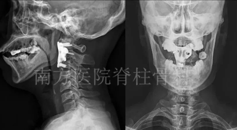 人口腔肉瘤_口腔卡波西肉瘤图片(2)