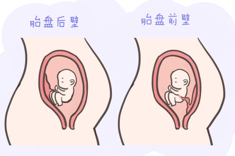 怀孕后,胎盘前壁和后壁有什么区别?这个位置很