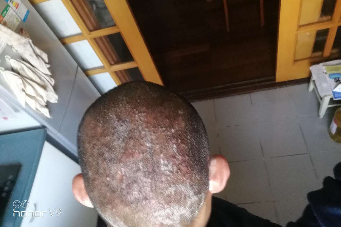 5年毛囊炎患者亲测林雯抗菌剂的清抑养根除方案,一直复发的毛囊炎