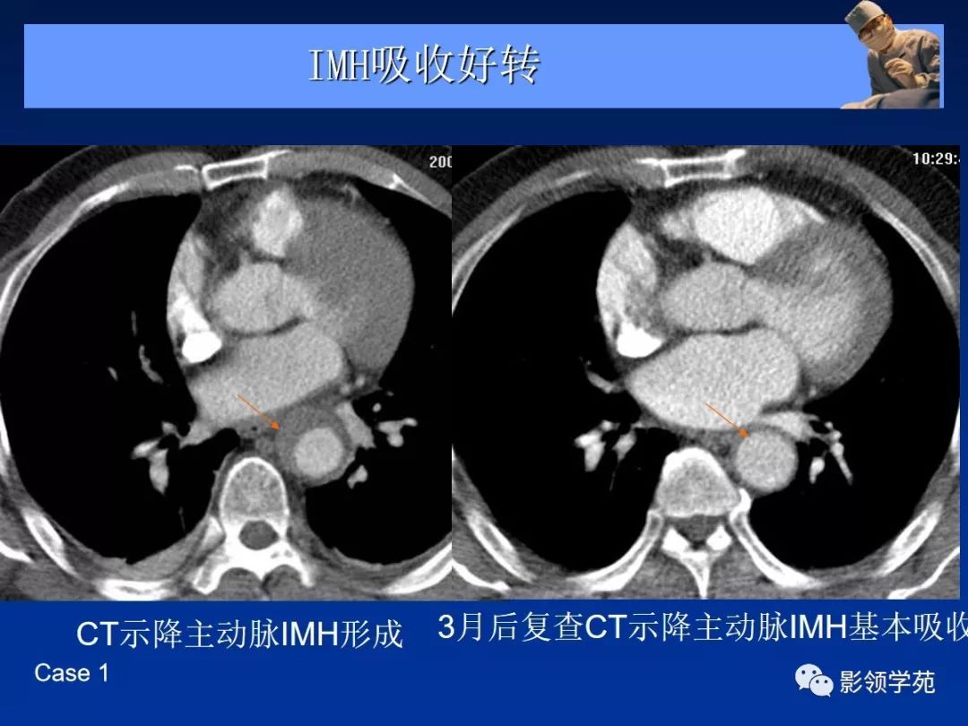 主动脉夹层壁间血肿及穿通性溃疡影像诊断与鉴别