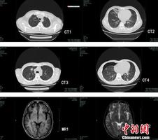 小伙吃生蟹患肺吸虫病脑部被感染 所幸就医及时