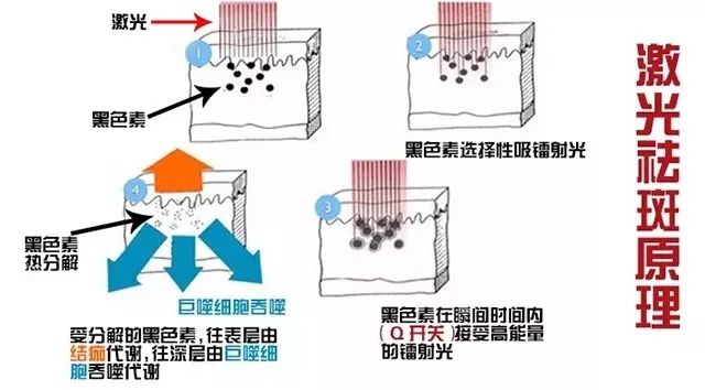 激光去斑什么原理_激光去斑