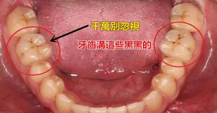 明明每次都刷牙3分钟了,那些黑色的是什么?_黑线