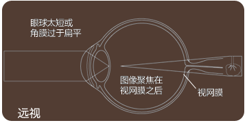 正常眼 和 近视眼 最大的 区别是什么?