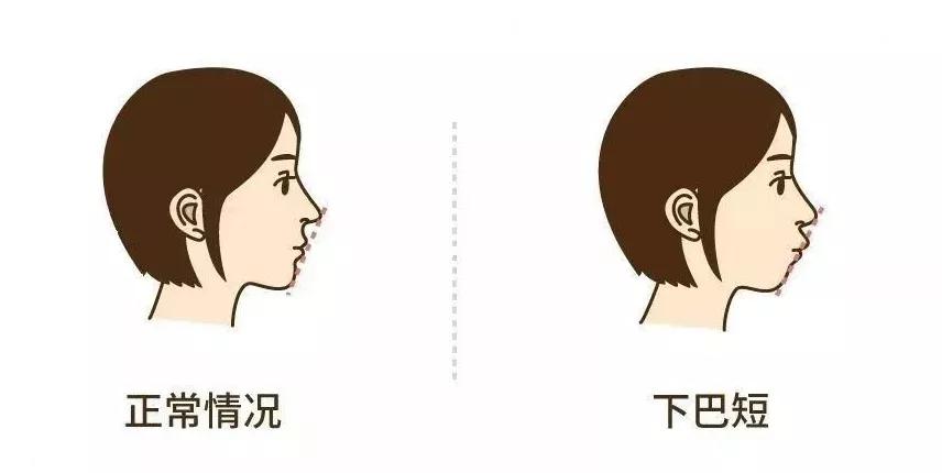 "小下巴"—小下颌畸形"歪脸"—颜面不对称畸形正颌外科手术通过移动