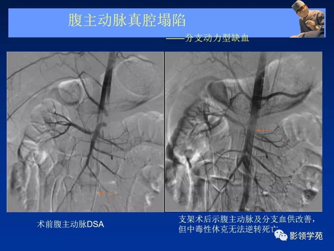 什么是主动脉夹层呢 96770c8302db4ede93a3f7b853bc48d9.jpeg